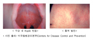 전 세계는 지금 홍역 앓이 중